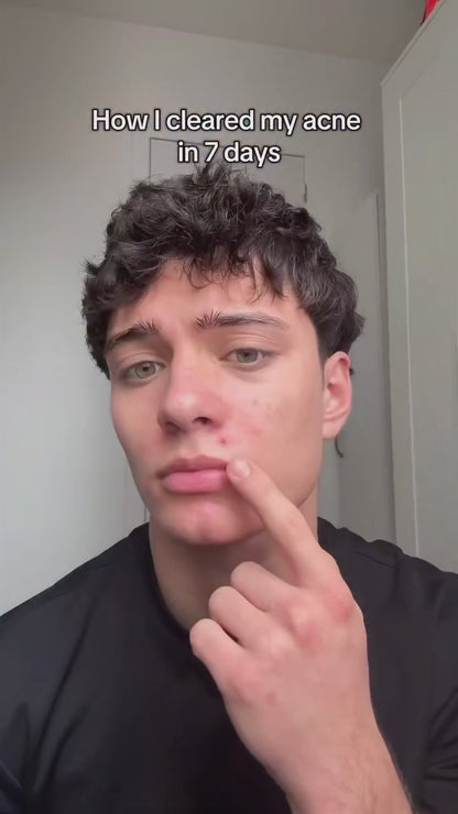 Azelaic acid 10+ hyaluron ANUA